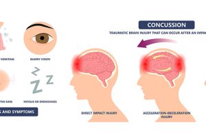 Dr. Colby Staubs Now Certified in ImPACT Testing – Concussion Protocol: What It Means for Athletes and Families in St. Petersburg