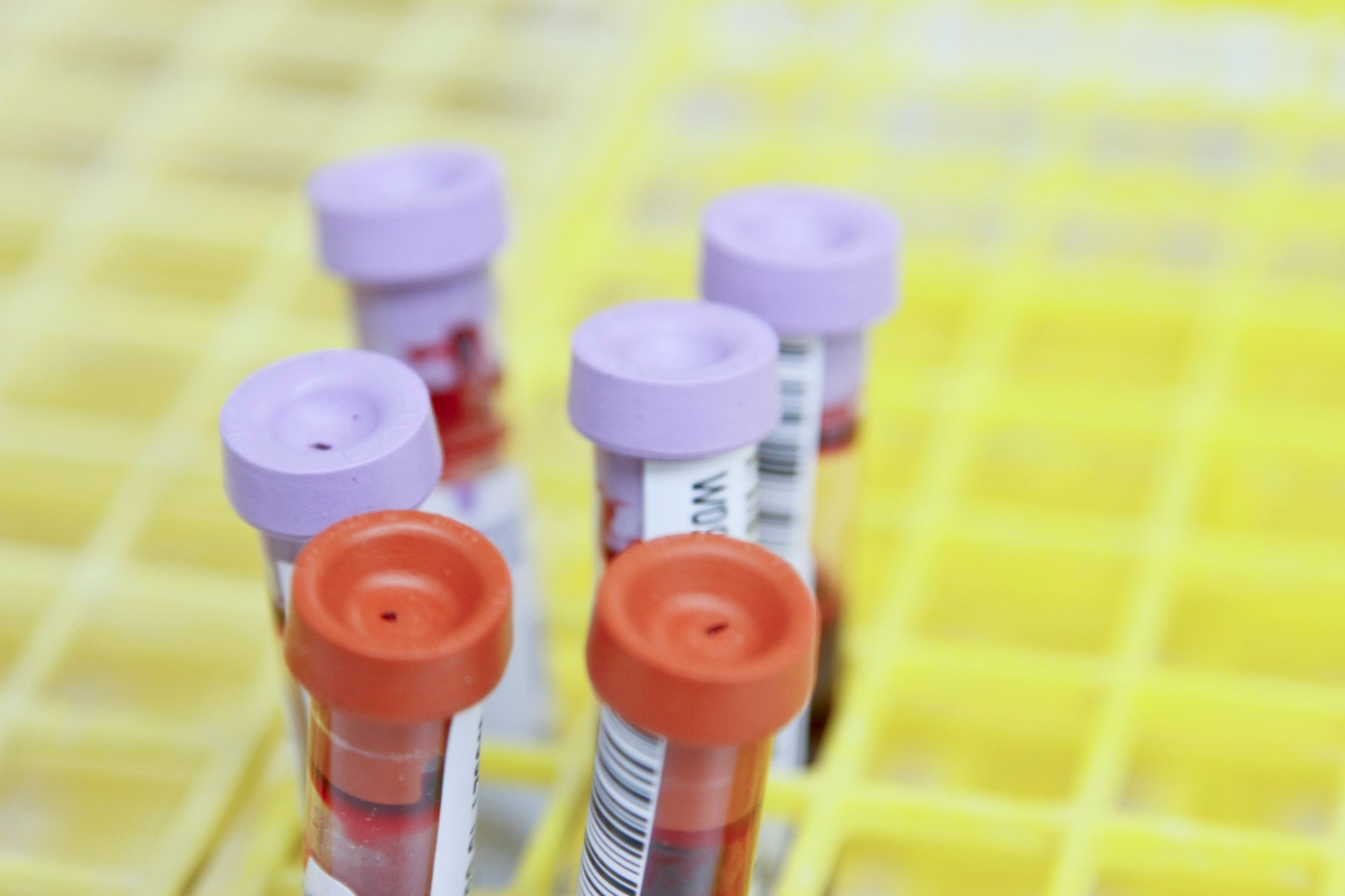 PRP blood preparation for carpal tunnel care